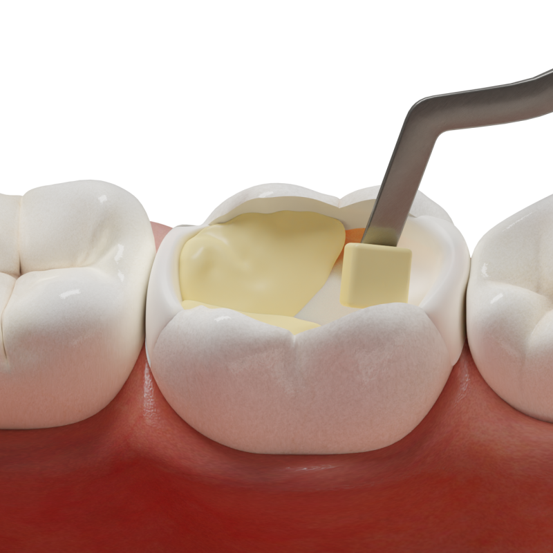 Large Restorations with Fiber-Reinforced BulkFill