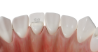 Crown Retention with Flexible Pins