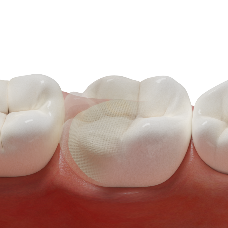 Large Restorations with Glass-Fiber Membrane